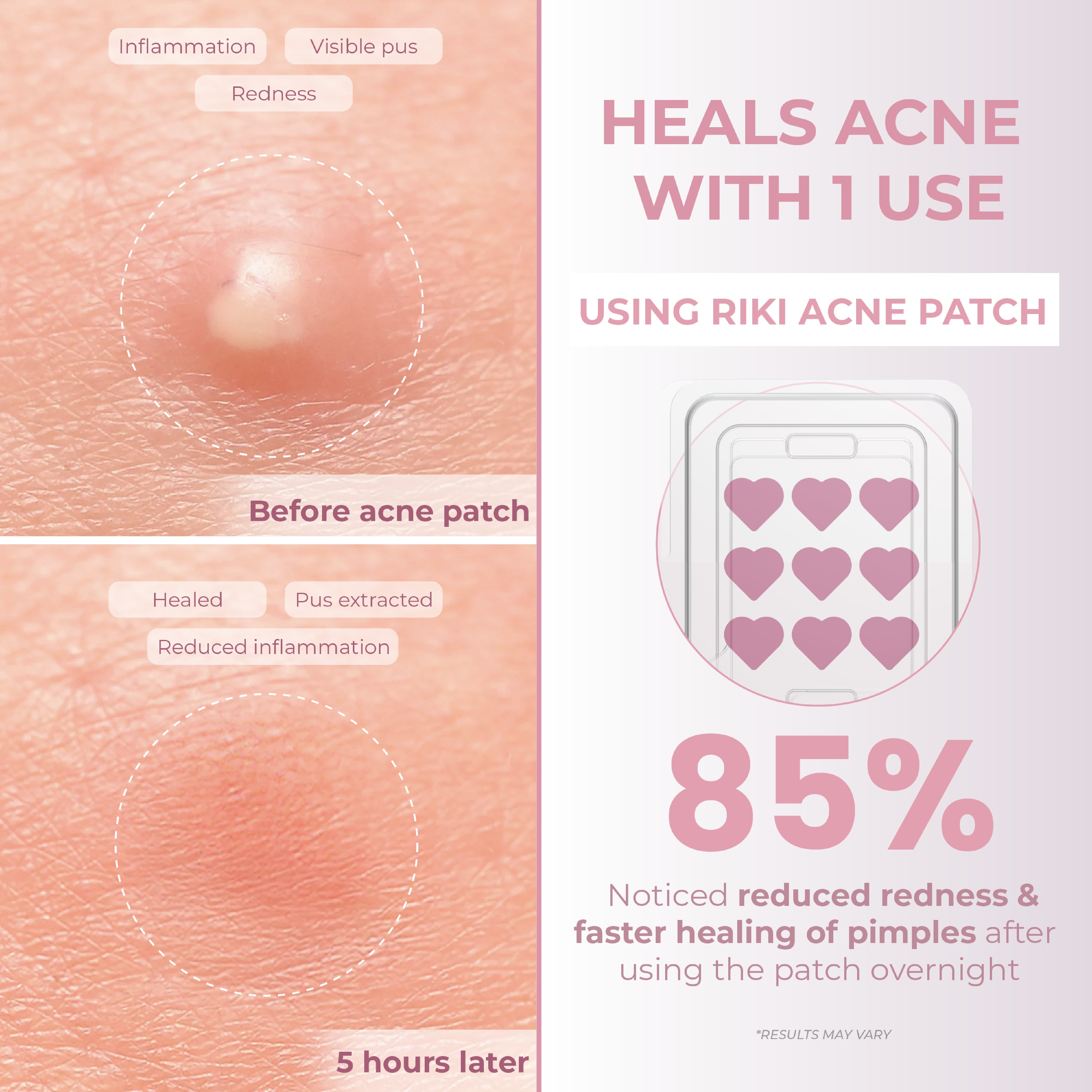 RIKI Acne Patch