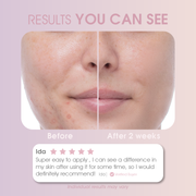 Compact recharging case for RIKI Miracle LED Therapy Acne Patch, ideal for travel and storage