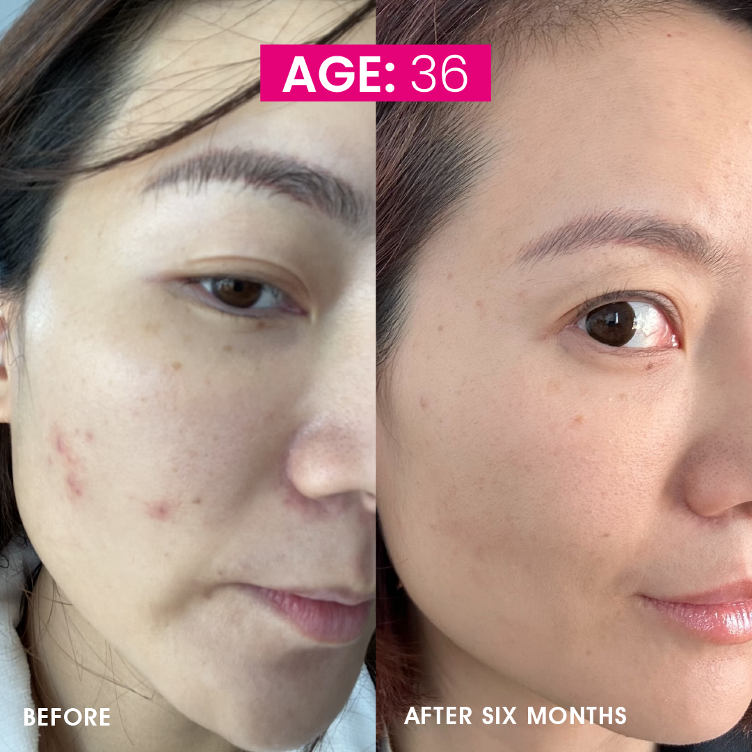 Witness the stunning transformation with the RIKI Baby Face LED Therapy Mask, showcasing incredible before-and-after results.